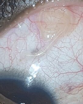 NEOflorax a ajutat să scape de un vierme din ochi